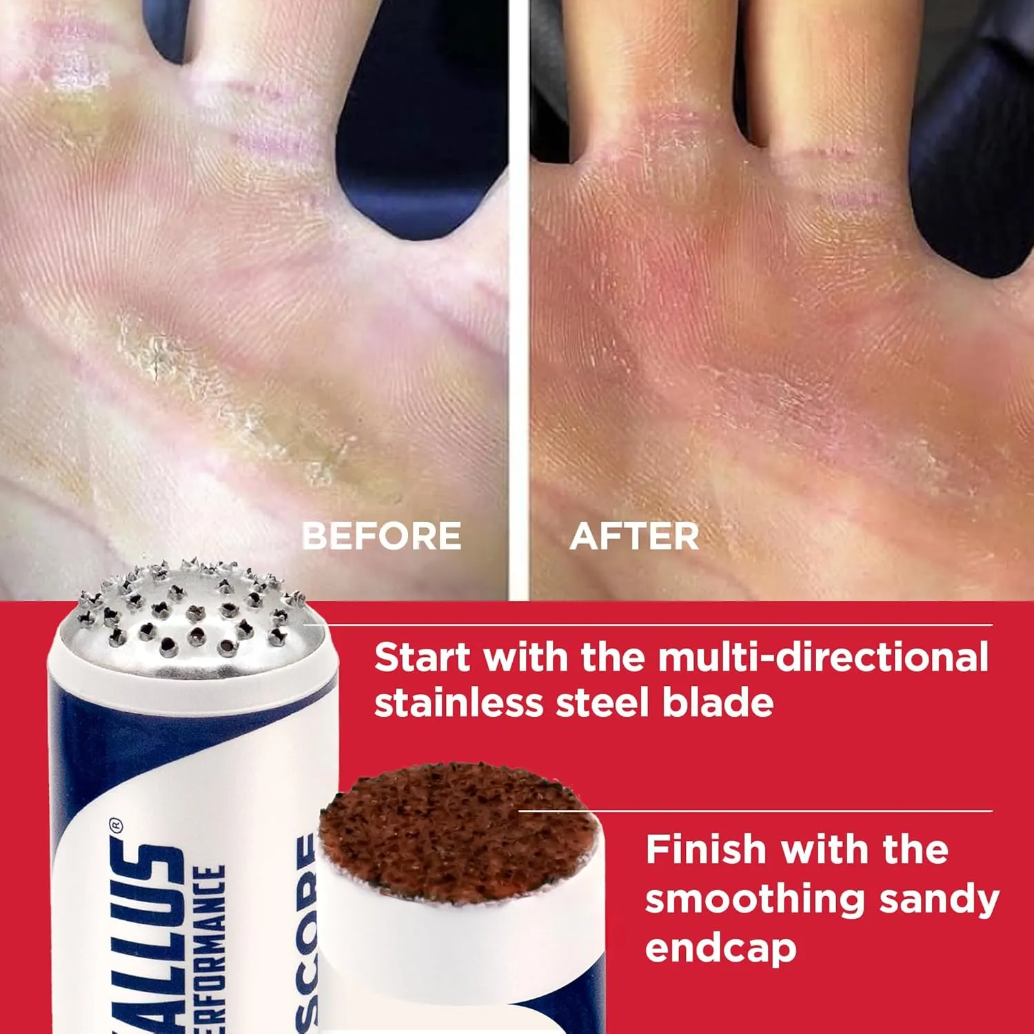 Callus Score – Ultimate Precision Hand Callus Remover | Prevents Ripping | Smoother for Athletes, Weightlifters & Gym Enthusiasts | Solution for Dry, Rough Hands & Fingers