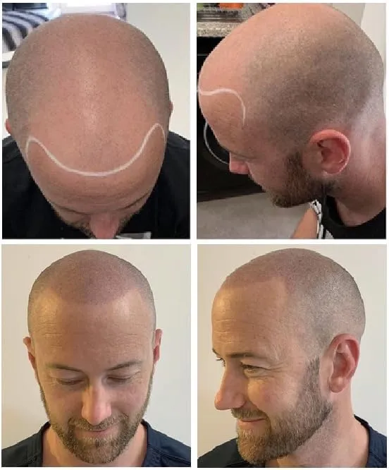 Dermdot SMP Pigment & Needle Kit – Scalp Micropigmentation Ink, Superior Retention, 15ml for 50  Treatments, Includes 20 Sterile Needles, Mixer, Syringes & More, Brown