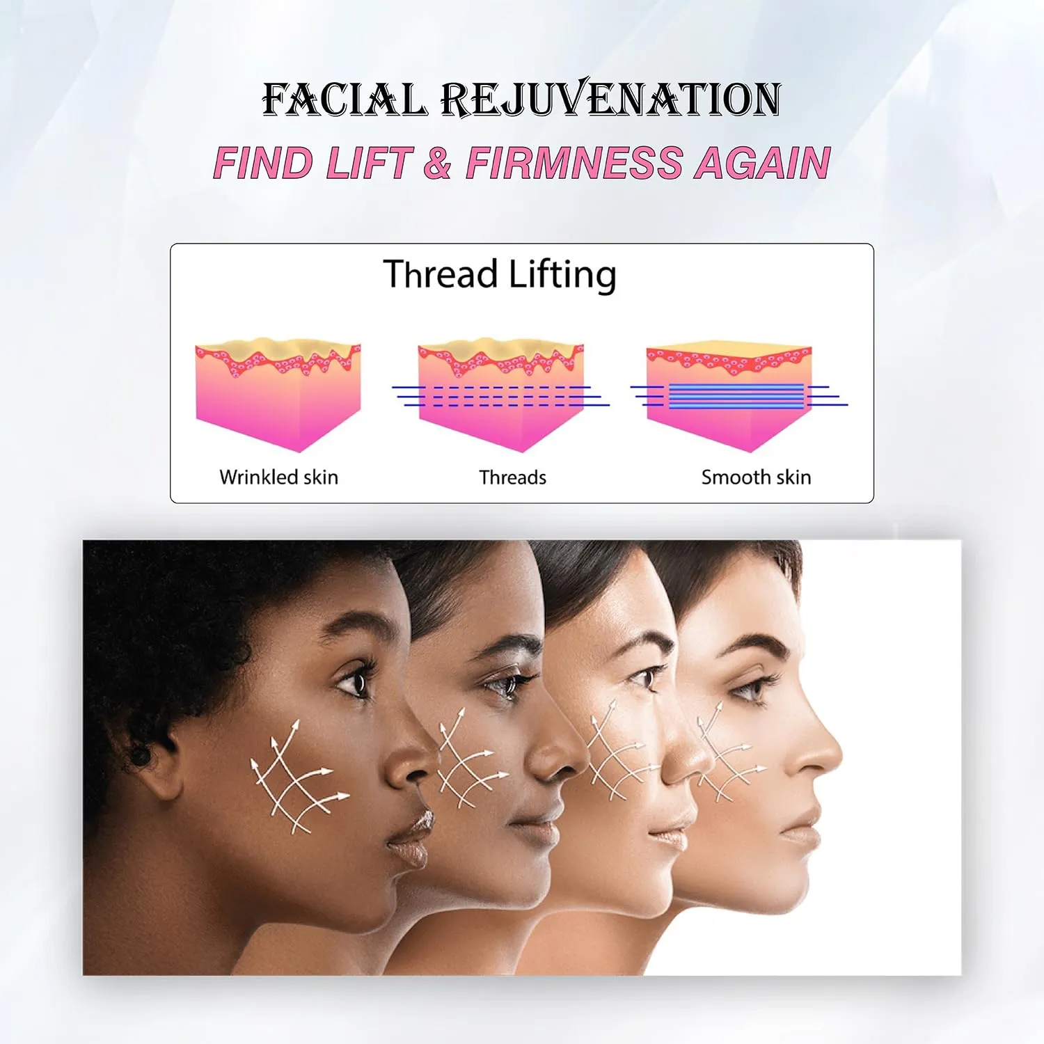 Pdo Threads Lift 27G50mm, Pdo Threads for Face Lift, Pdo Mono Threads for Whole Body Lifting Collagen Threads for Wrinkles 20PCS Thread Face Lift