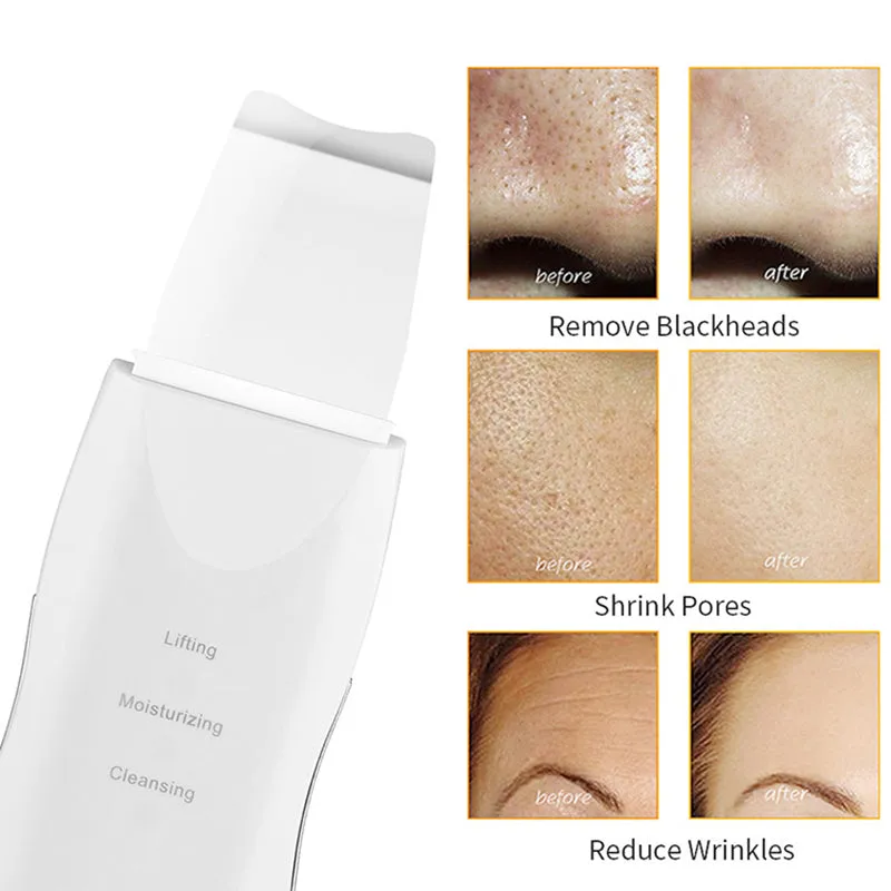 Ultrasonic Ion Facial Massager Blackhead On Face Remove Acne